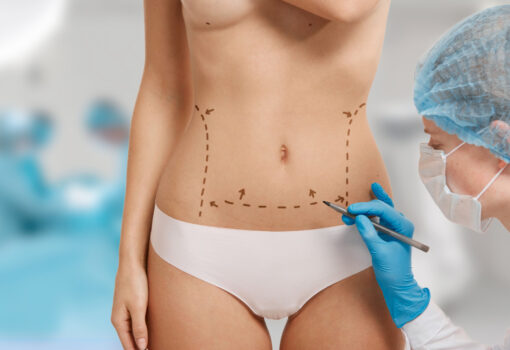 Liposuction